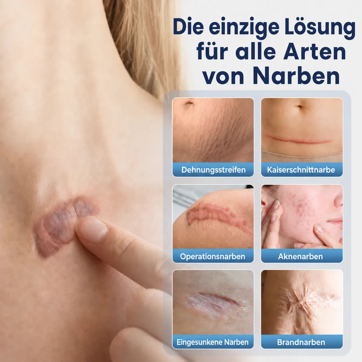 🛒drilena® Reparierende Anti-Narben-Creme — Dehnungsstreifen, Narben & Aknemale