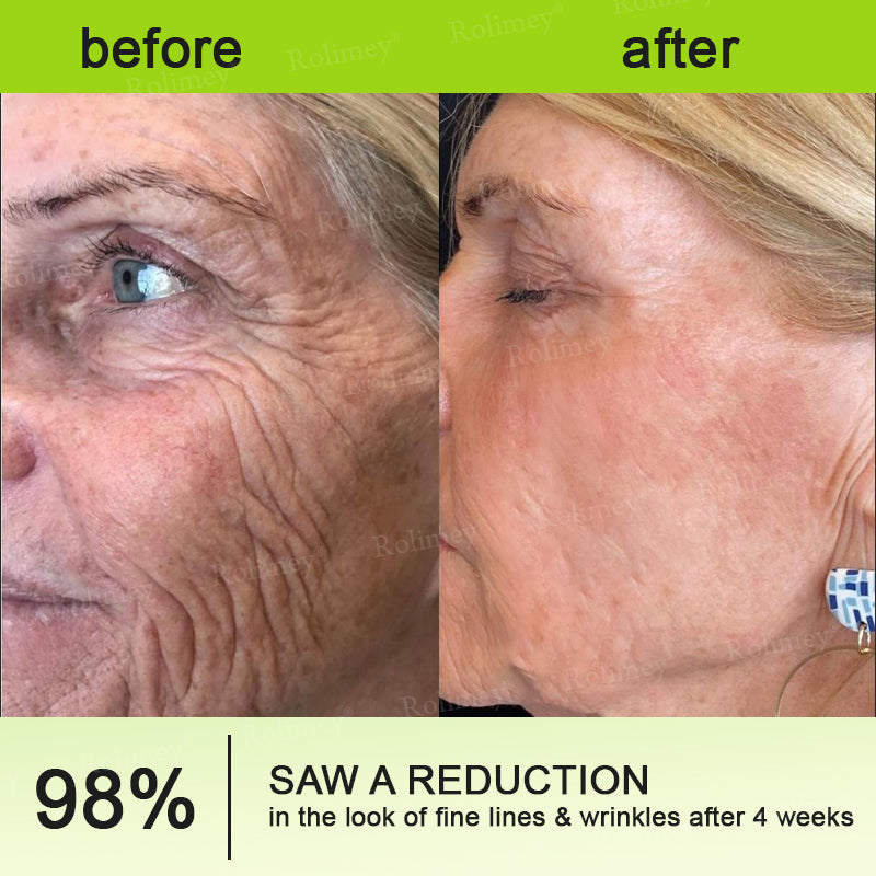 💧Made and shipped from the IE🧑‍⚕️💫Rolimey® Botox & Vita-A Retinol Shot Wrinkle-Lift Tightening cream - Last Day Promotion 70% OFF