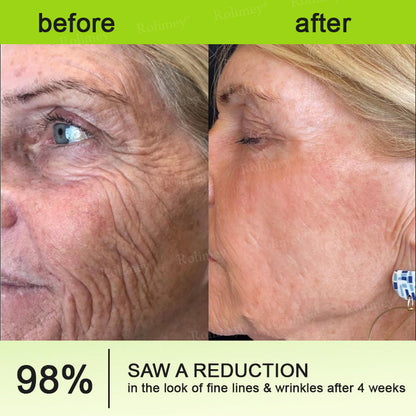 💧Made and shipped from the IE🧑‍⚕️💫Rolimey® Botox & Vita-A Retinol Shot Wrinkle-Lift Tightening cream - Last Day Promotion 70% OFF