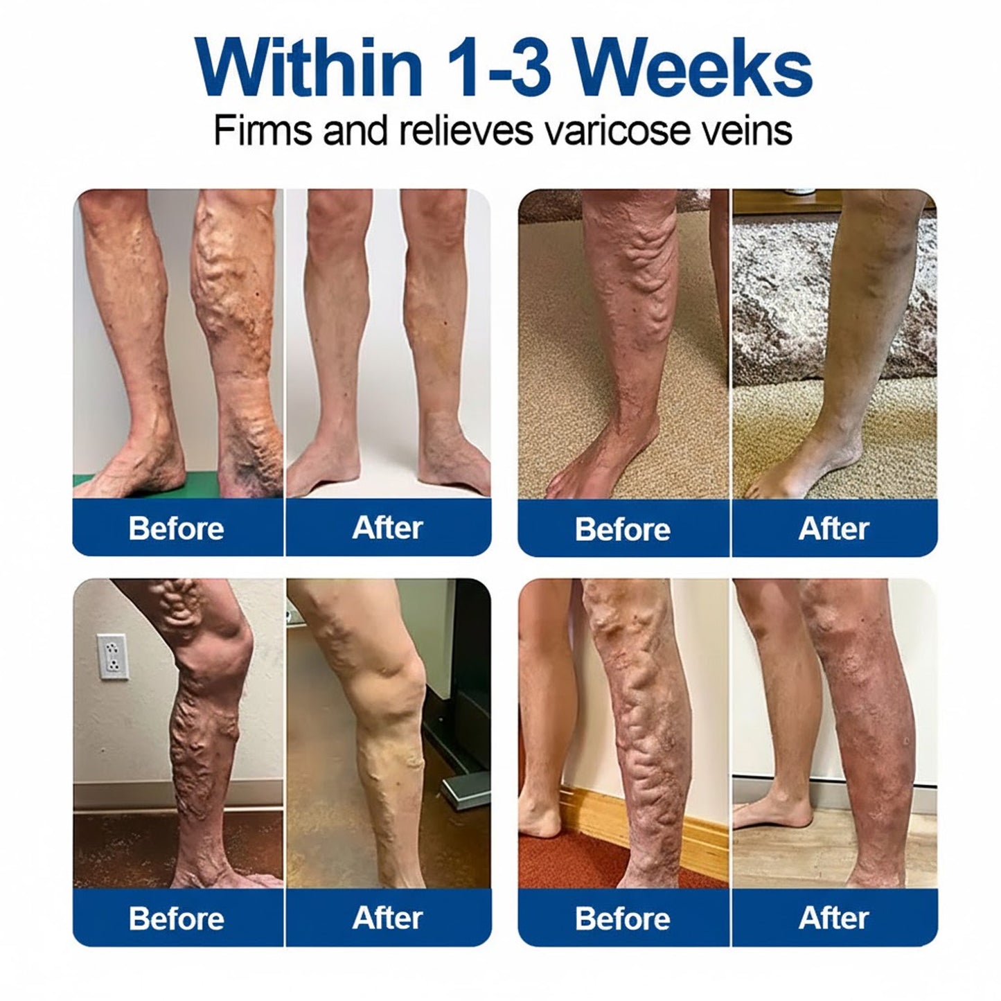 🇮🇪👨‍⚕️❄️GFOUK® VeinEase Microneedle Care Patch⚡Instant Relief, Long-Term Results