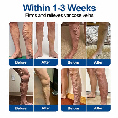 🇮🇪👨‍⚕️❄️GFOUK® VeinEase Microneedle Care Patch⚡Instant Relief, Long-Term Results