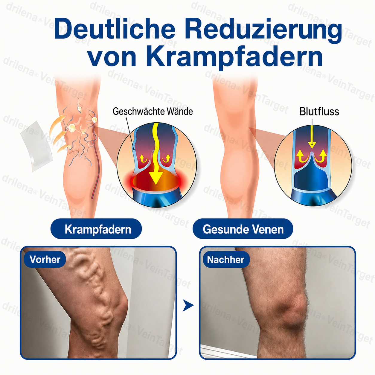 🧙 drilena® VeinTarget – Mikronadelpflaster ⚡ Sofortige Linderung, langanhaltende Ergebnisse