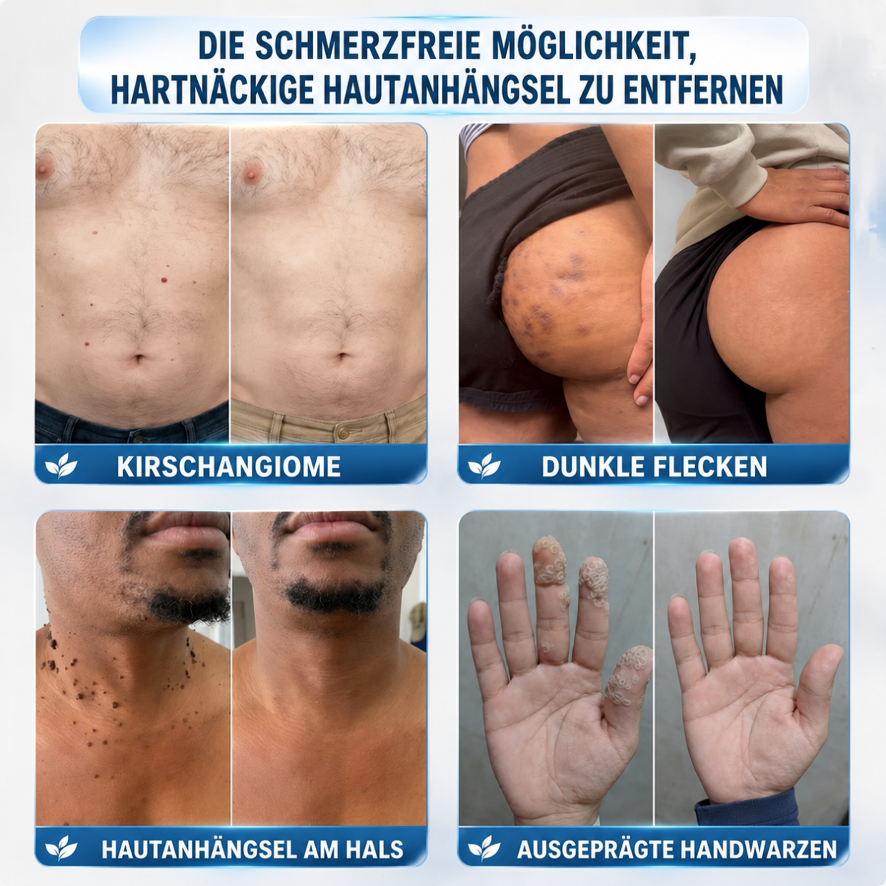 🛒drilena®7-Tage Hautanhängsel- & Fleckenentferner – schmerzfrei & narbenfrei Fortschrittlicher Roll-on-Stift zur Entfernung von Hautunreinheiten