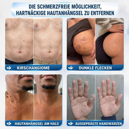 🛒drilena®7-Tage Hautanhängsel- & Fleckenentferner – schmerzfrei & narbenfrei Fortschrittlicher Roll-on-Stift zur Entfernung von Hautunreinheiten