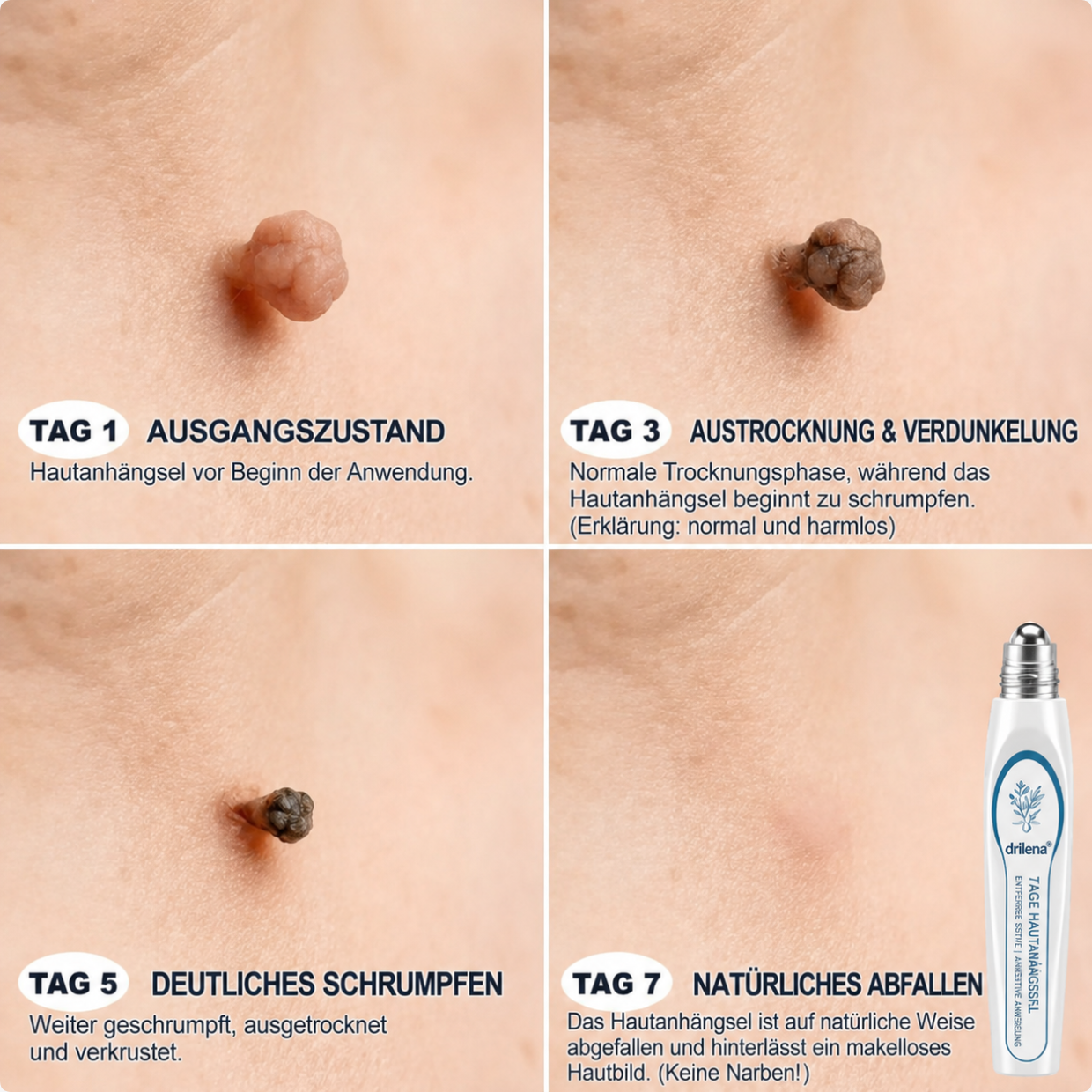 🛒drilena®7-Tage Hautanhängsel- & Fleckenentferner – schmerzfrei & narbenfrei Fortschrittlicher Roll-on-Stift zur Entfernung von Hautunreinheiten