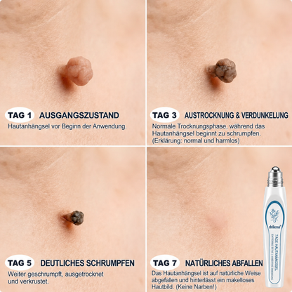 🛒drilena®7-Tage Hautanhängsel- & Fleckenentferner – schmerzfrei & narbenfrei Fortschrittlicher Roll-on-Stift zur Entfernung von Hautunreinheiten
