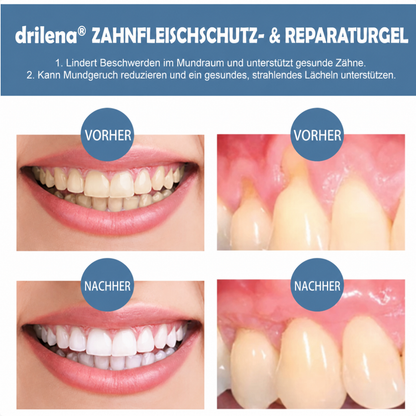 ✨drilena® Zahnfleisch-Reparaturgel | Professionelles Gel zur Zahnfleischregeneration