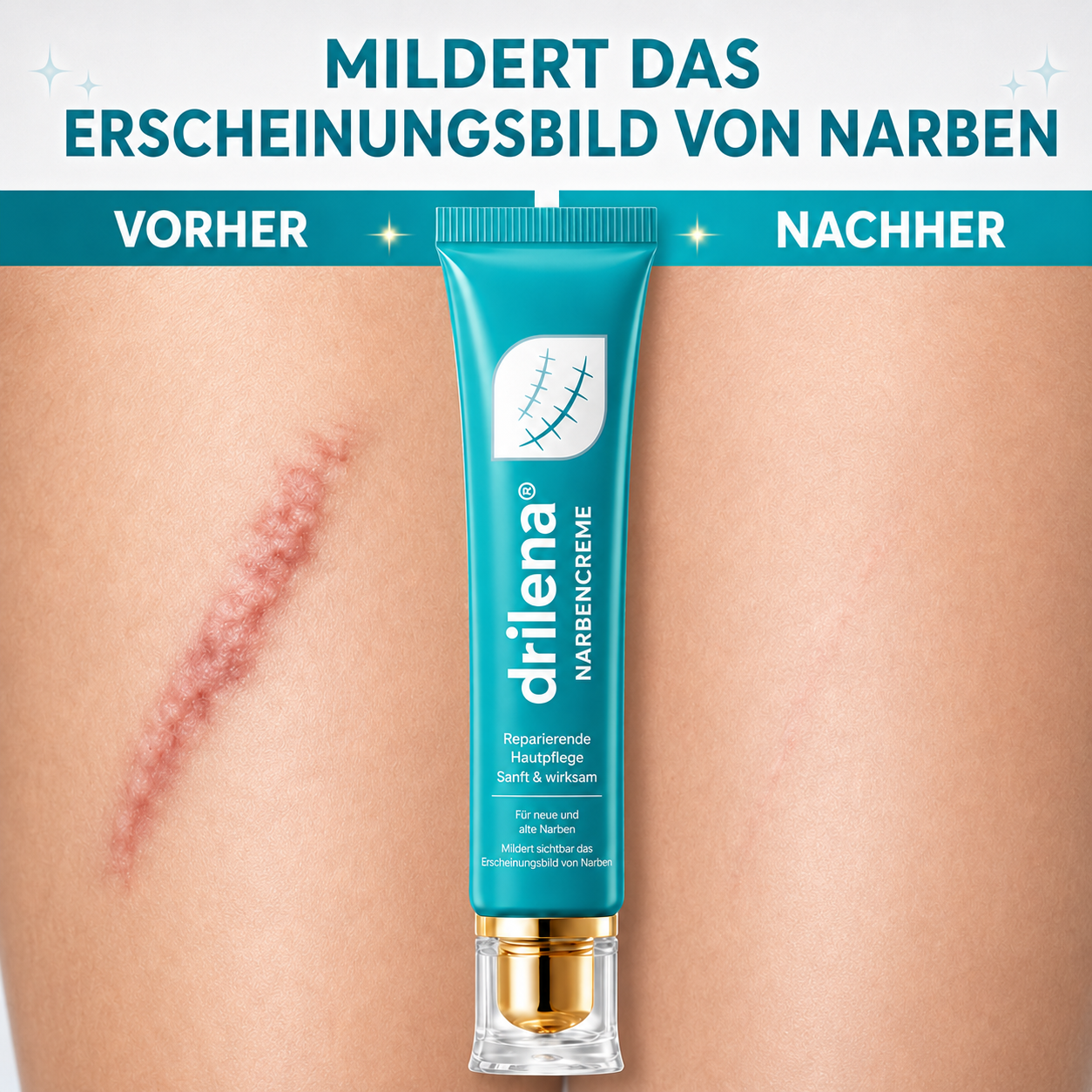 🆙drilena® Reparierende Anti-Narben-Creme — Dehnungsstreifen, Narben & Aknemale